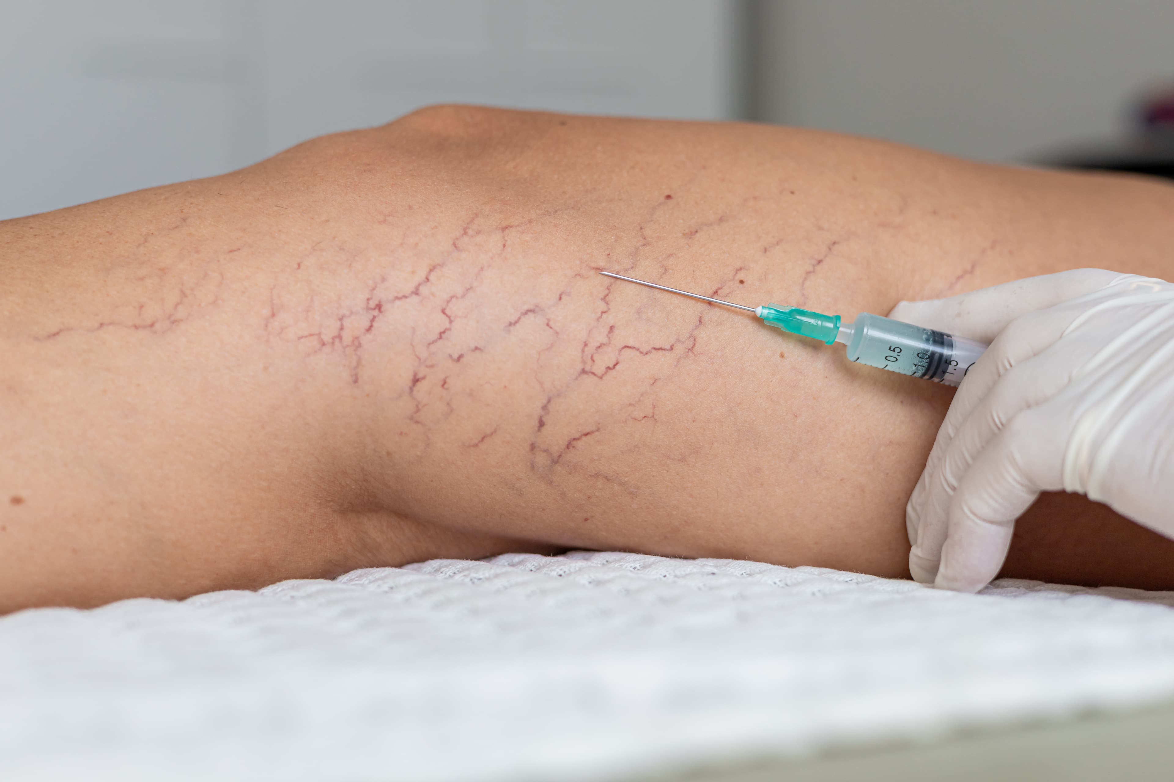A sclerotherapy injection treating spider veins on the leg