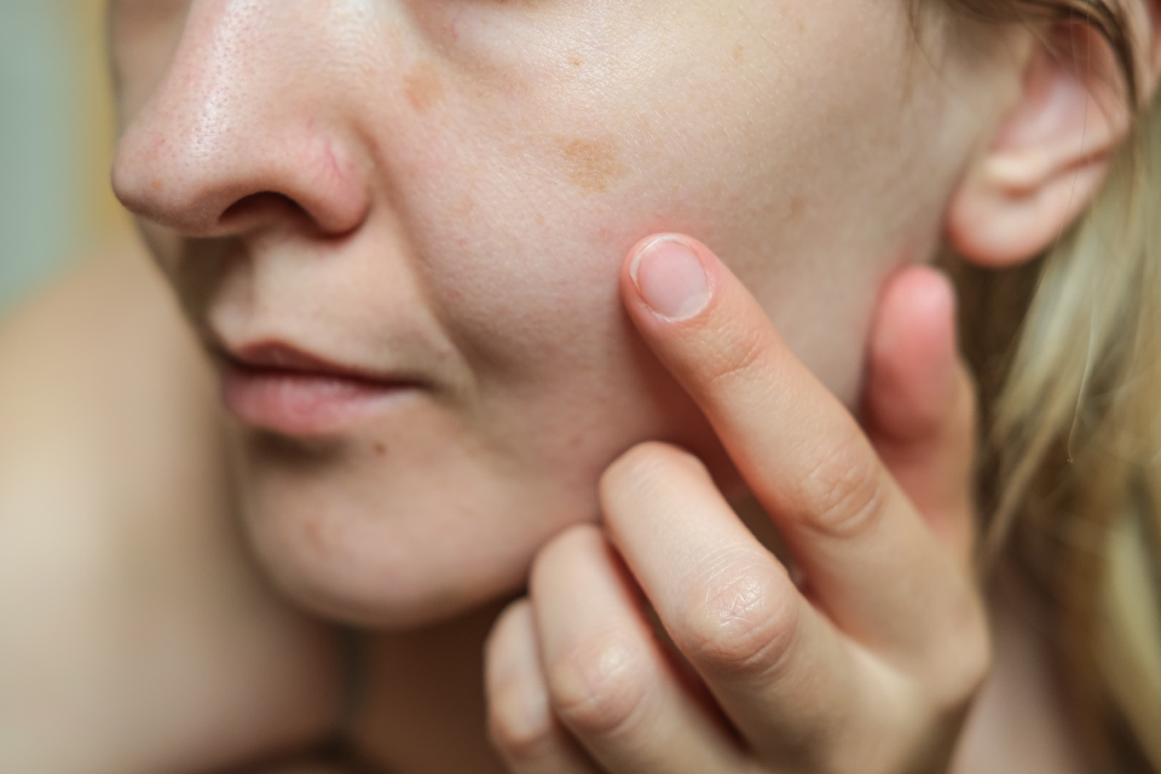 A close-up of a dark spot on a woman's cheek