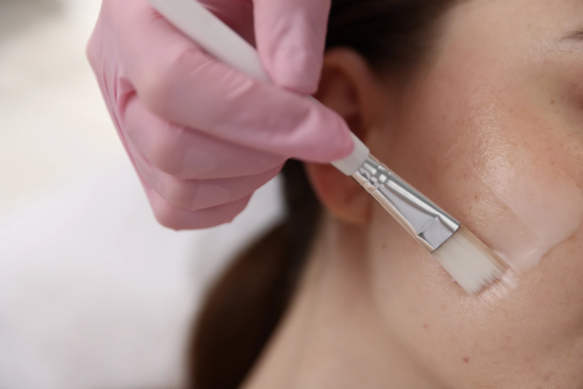 A gloved provider applying a chemical peel solution to a client's cheek with a brush.
